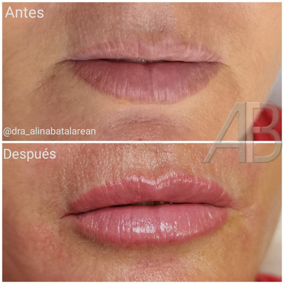 Aumento de labios con ácido hialurónico