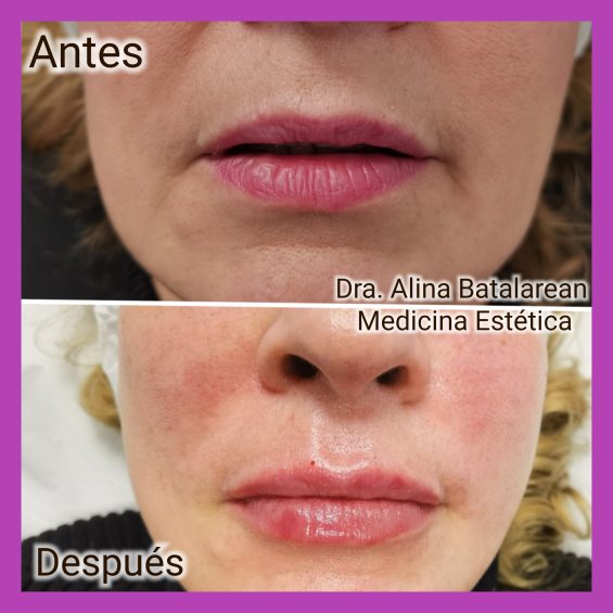 Aumento de labios con ácido hialuronico