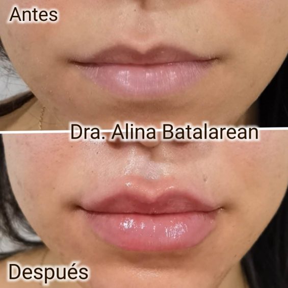 Relleno labios con ácido hialurónico