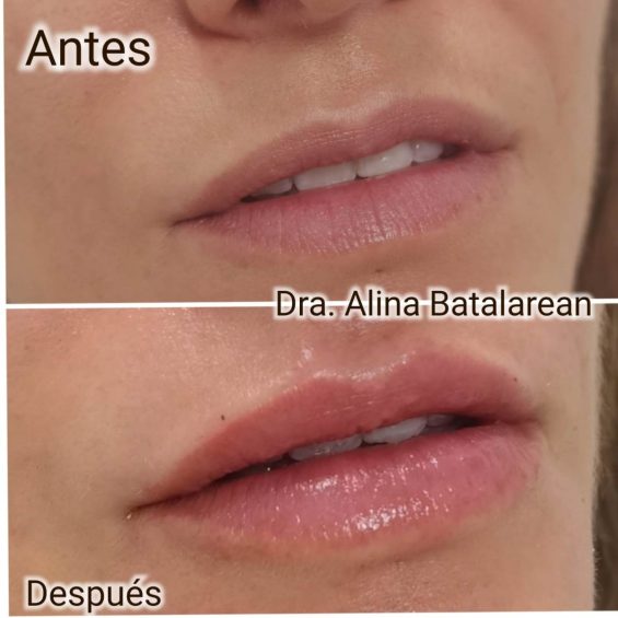 Relleno labios con ácido hialurónico